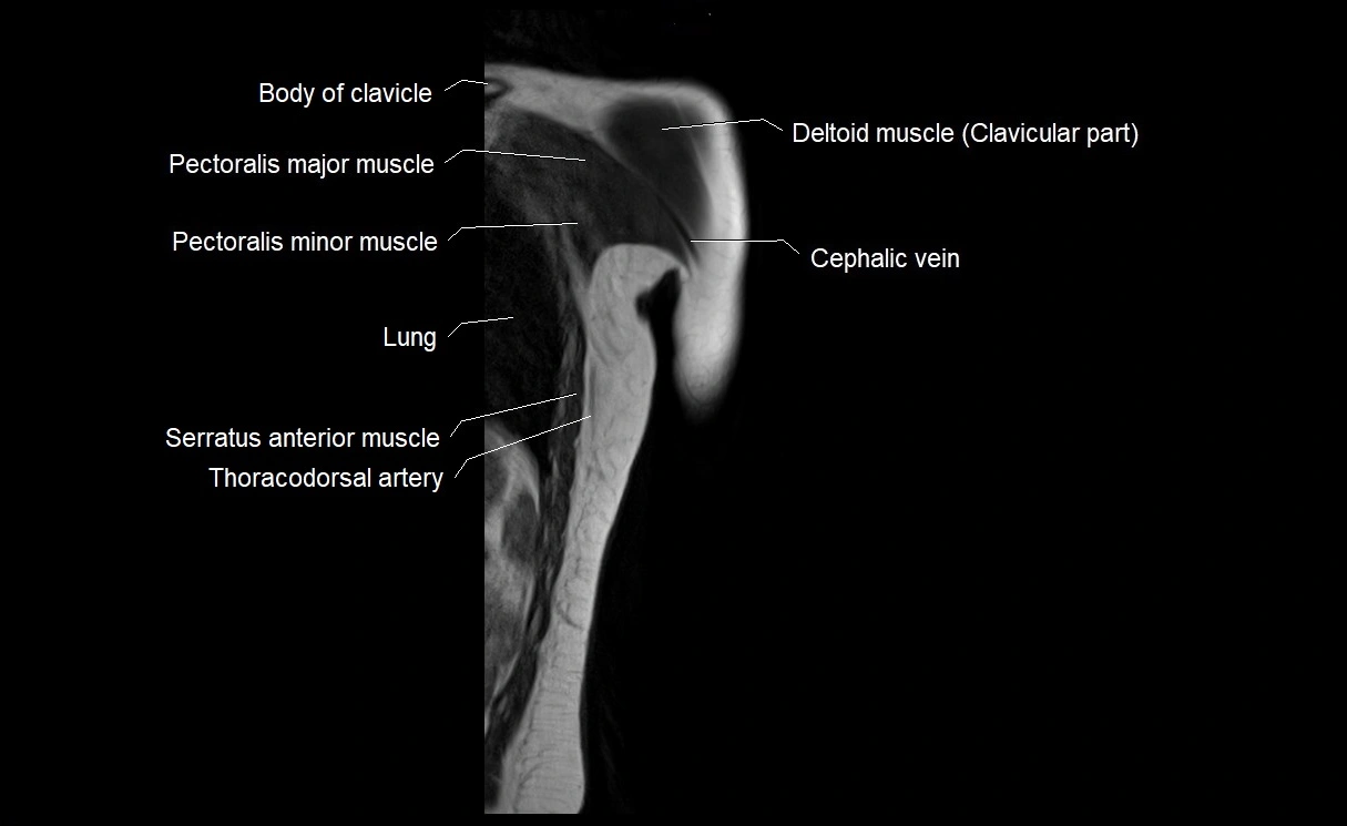 MRI upper arm (humerus ) coronal cross sectional anatomy image 1.webp
